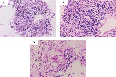 Pulmonary blastoma treatment response to anti-PD-1 therapy: a rare case report and literature review